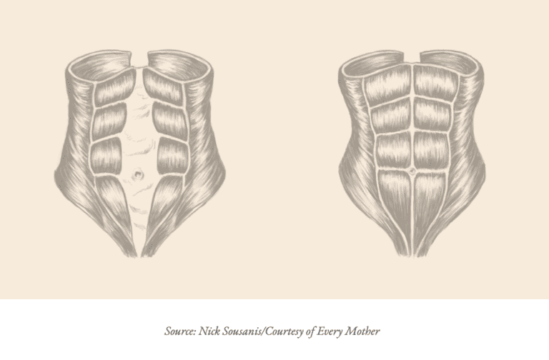 Diastasis Recti | What is Diastasis Recti? | Every Mother