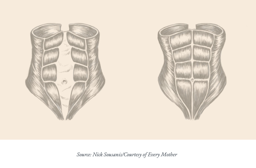 Diastasis Recti Is Very Common, And Goes Beyond A 'Mom Pooch
